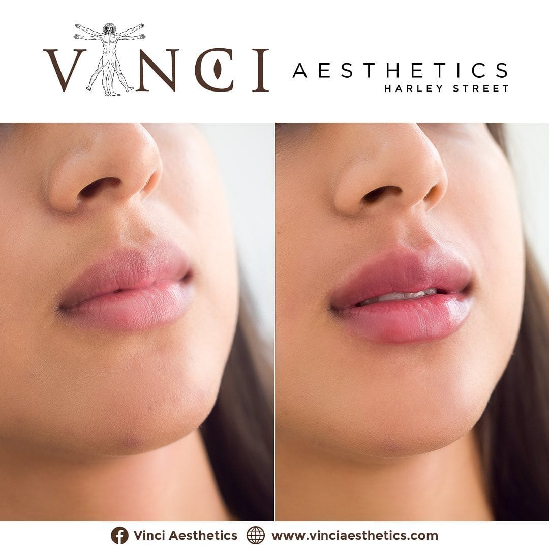 Post 7 by Vinci Aesthetics on Instagram (carousel)