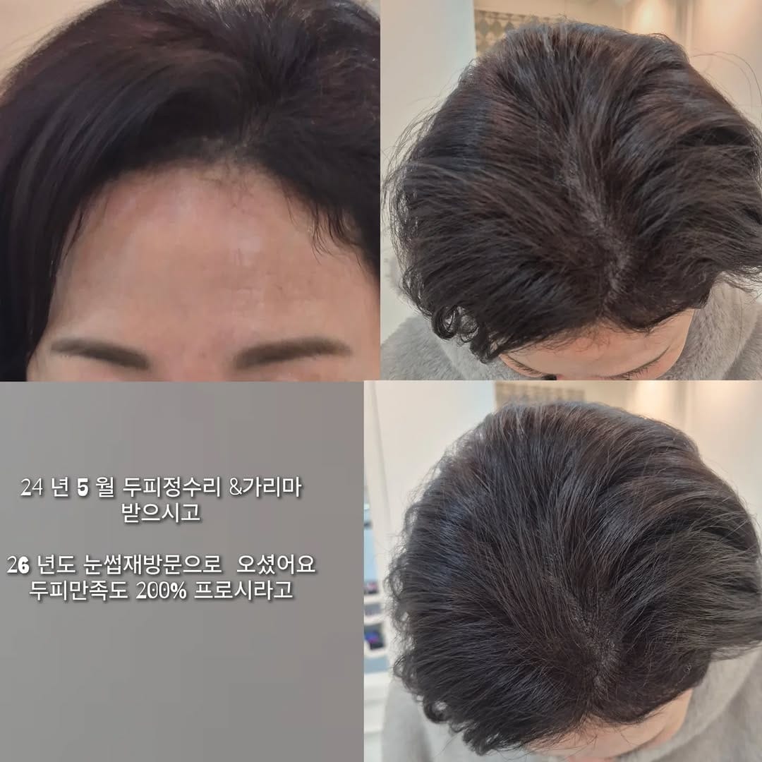 Post 2 by 대전입술문신 대전눈썹문신 대전아이라인문신 /어나더블랙 대전두피문신  🥇대전캐츠아이 on Instagram (carousel)