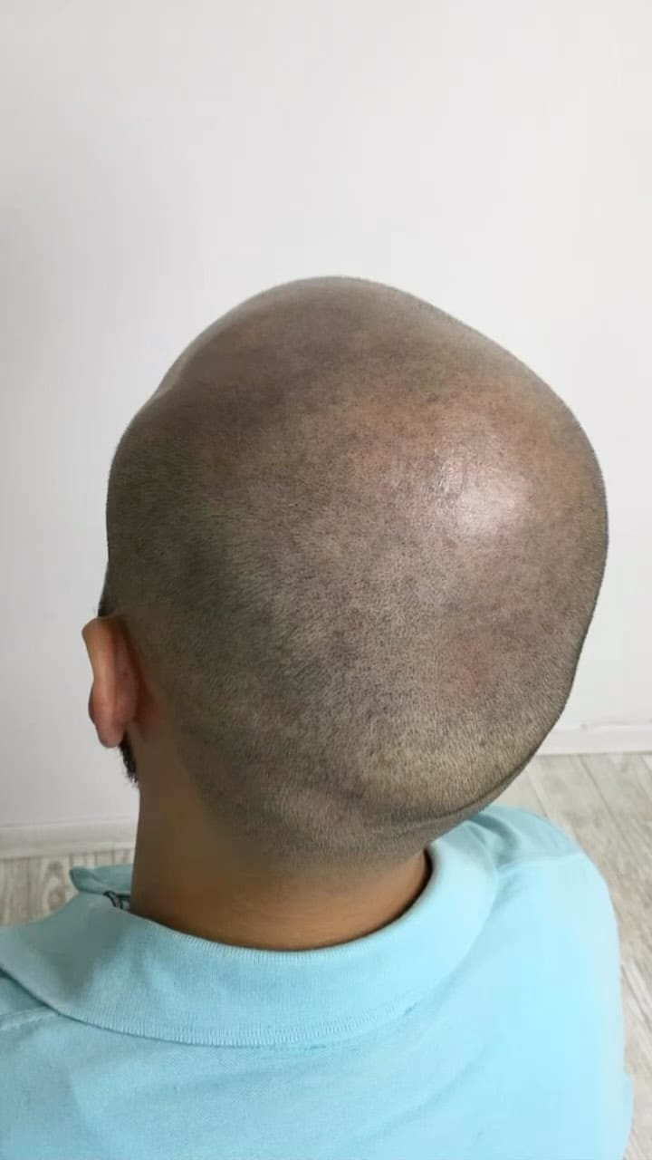 Post 3 by İHS Saç simülasyonu on Instagram (video)