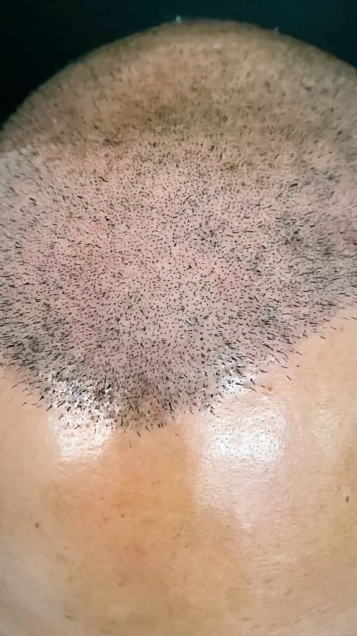 Post 7 by İHS Saç simülasyonu on Instagram (video)