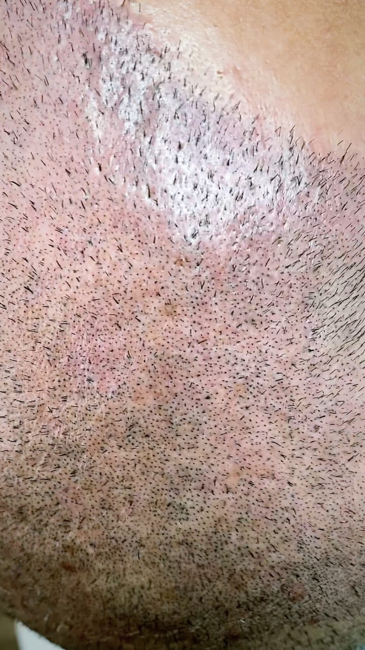 Post 6 by İHS Saç simülasyonu on Instagram (video)