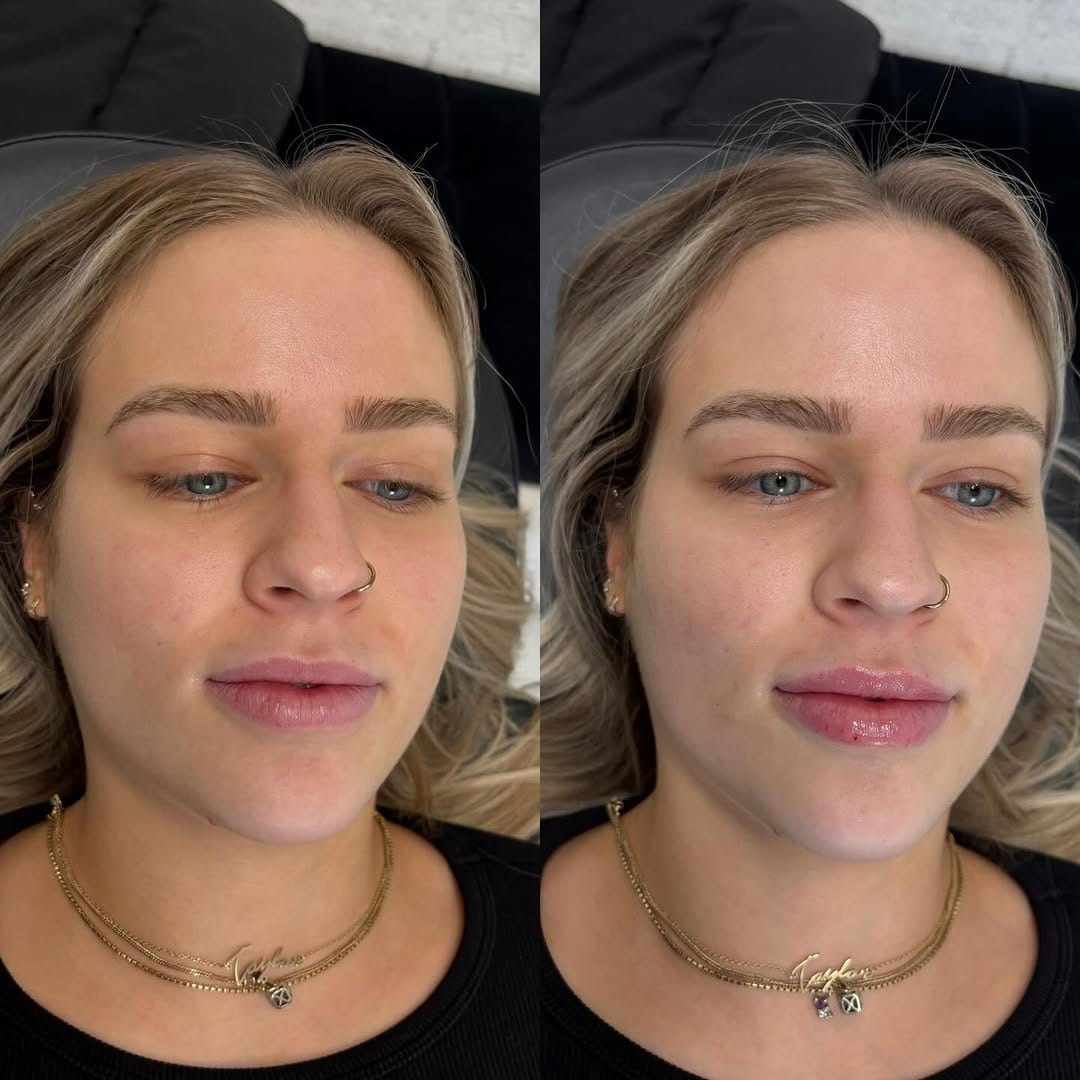 Post 2 by Shafroz RN BN | Botox, Filler, PRP, PRF, microneedling on Instagram (carousel)