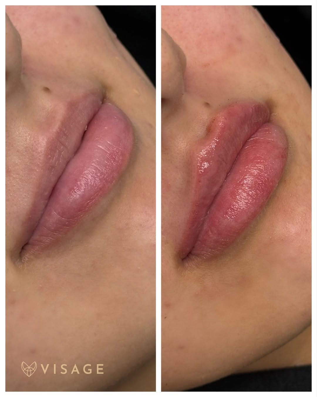 Post 9 by Shafroz RN BN | Botox, Filler, PRP, PRF, microneedling on Instagram (image)