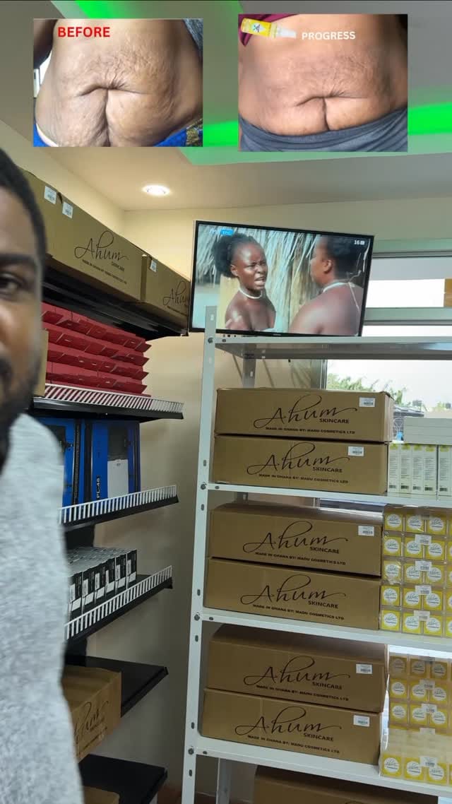 Post 8 by NO1 STRETCH MARK PRODUCTS on Instagram (video)