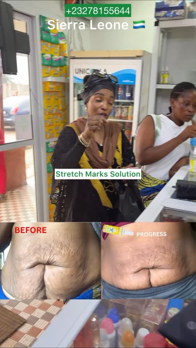 Post 10 by NO1 STRETCH MARK PRODUCTS on Instagram (video)
