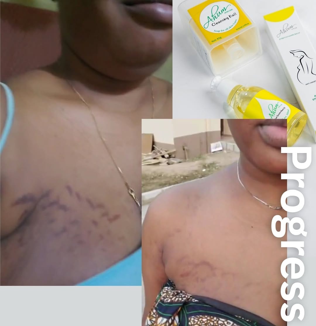 Post 5 by NO1 STRETCH MARK PRODUCTS on Instagram (image)