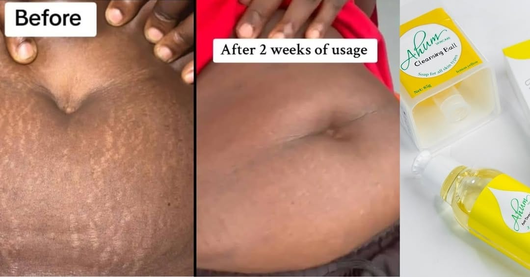 Post 6 by NO1 STRETCH MARK PRODUCTS on Instagram (image)