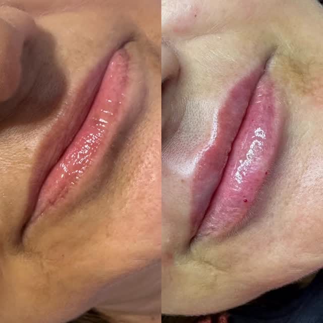 Post 9 by Marcia kochinski  Biomédica Esteta on Instagram (video)