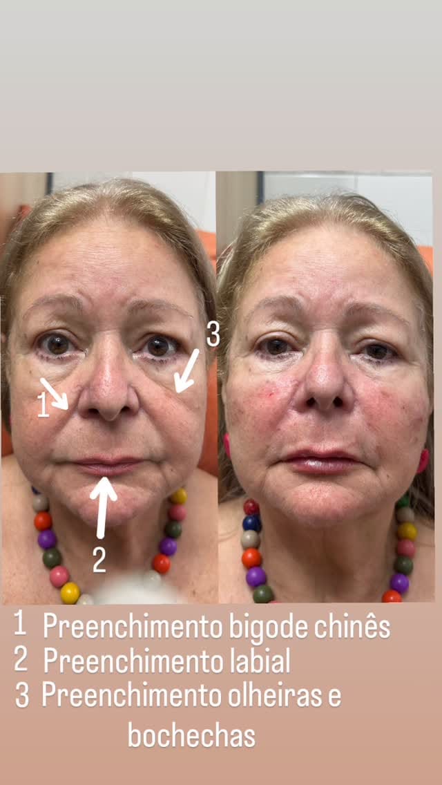 Post 6 by Marcia kochinski  Biomédica Esteta on Instagram (video)