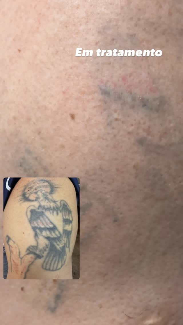 Post 4 by Poliana Bertunes | Remoção Tatuagem a Laser em SP on Instagram (video)