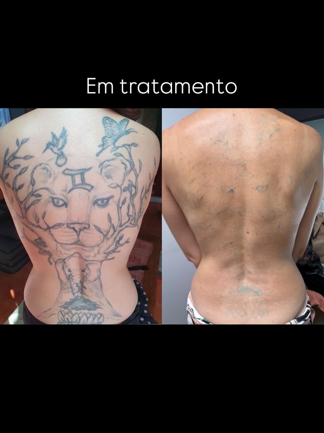 Post 1 by Poliana Bertunes | Remoção Tatuagem a Laser em SP on Instagram (image)
