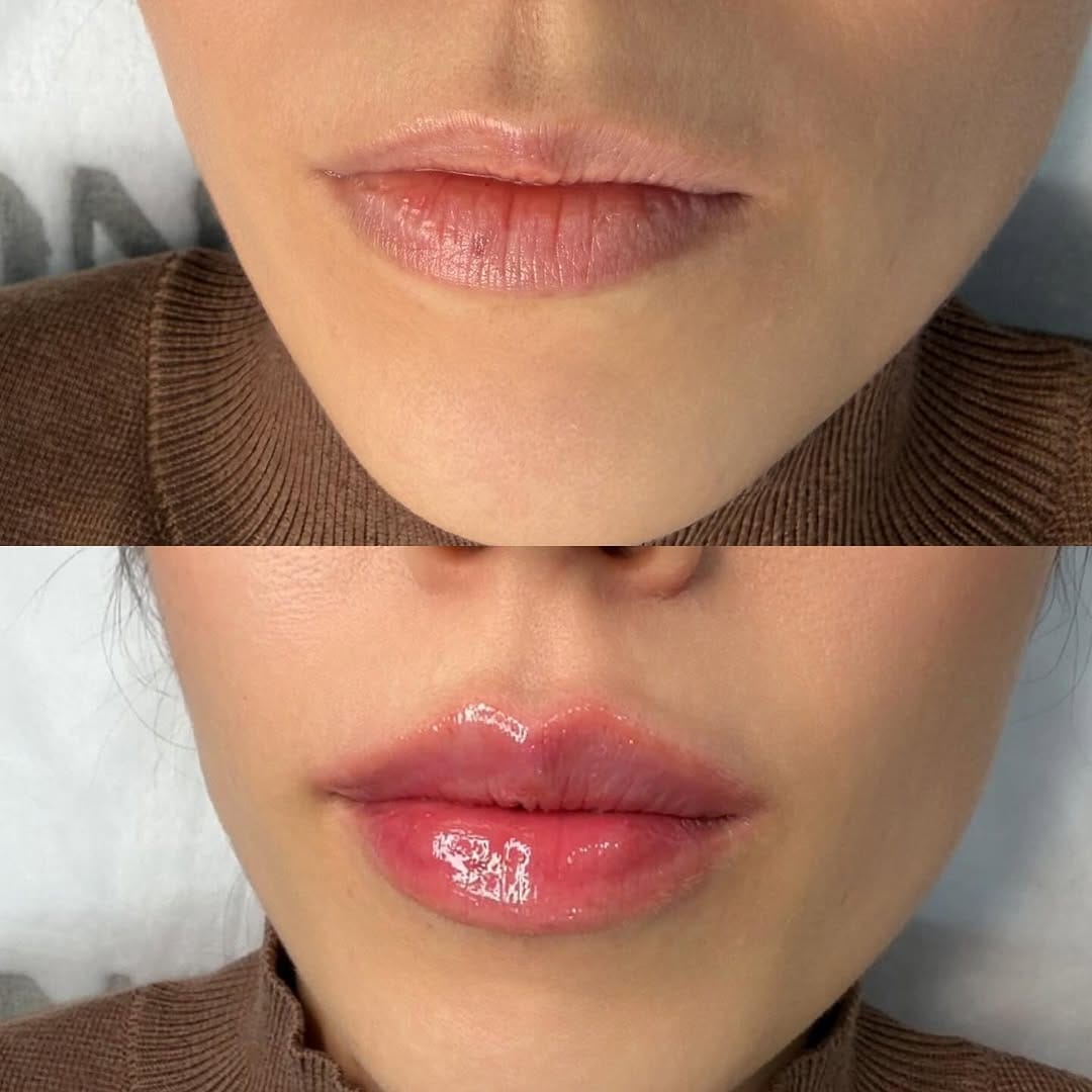 Post 1 by Dr.JEINA | Врач - КОСМЕТОЛОГ ЖЕЙНА 💉 ШЫМКЕНТ | АЛМАТЫ | ДУБАЙ on Instagram (image)