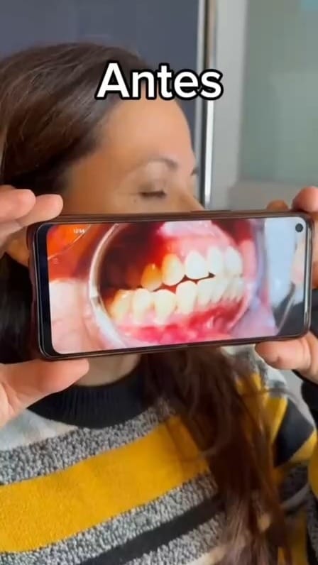 Post 2 by Top Aligners | Alineadores invisibles on Instagram (video)