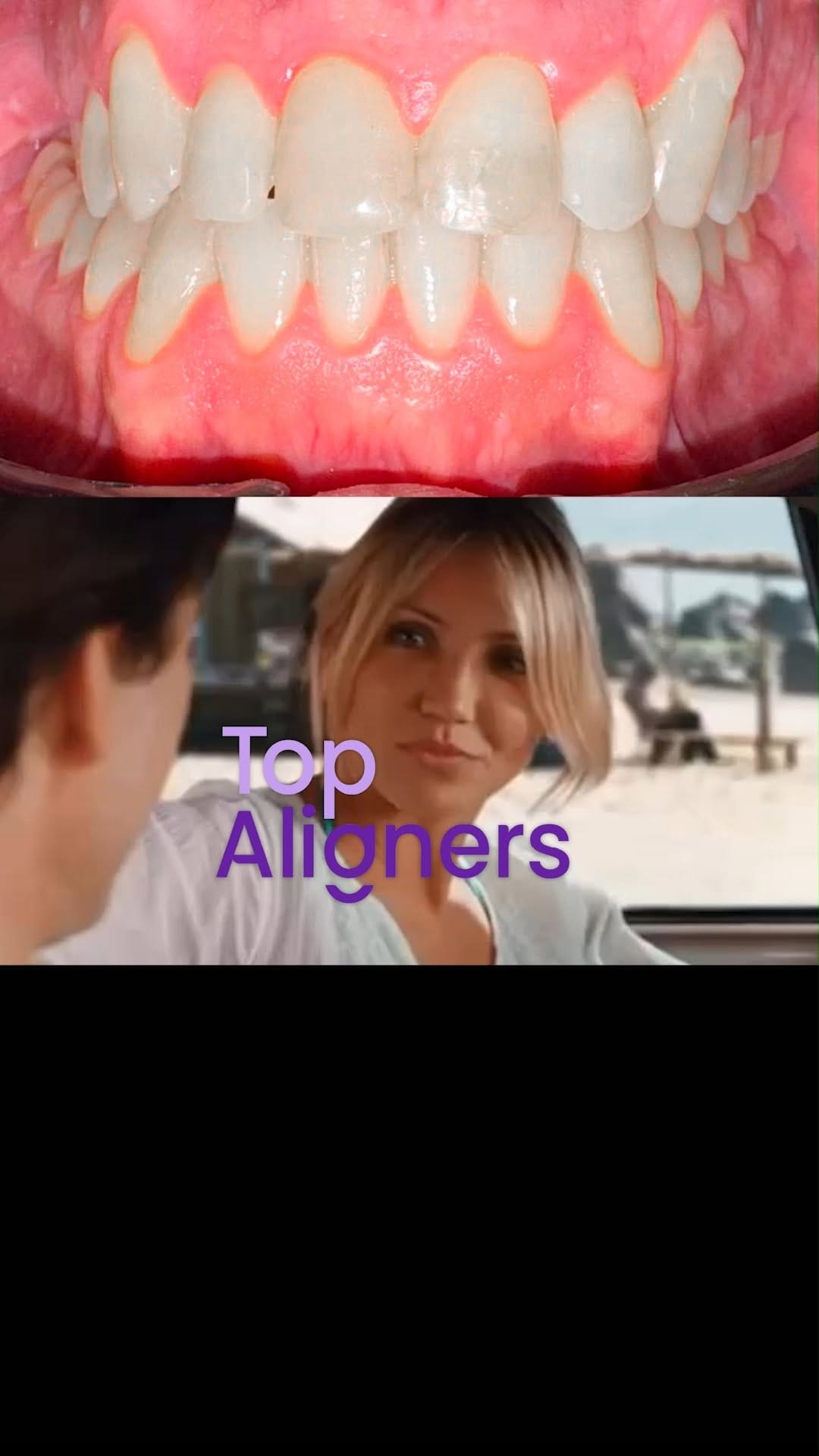Post 4 by Top Aligners | Alineadores invisibles on Instagram (video)