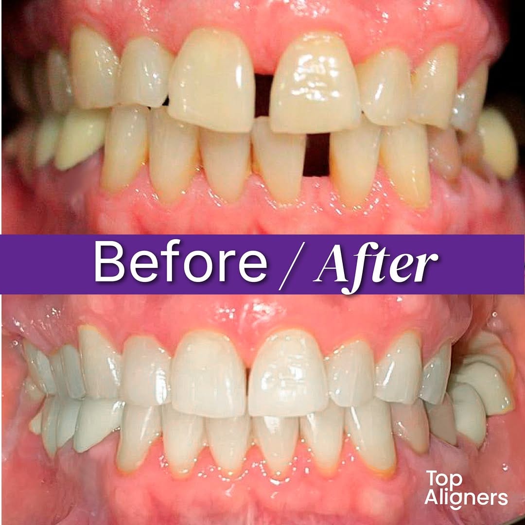 Post 7 by Top Aligners | Alineadores invisibles on Instagram (image)