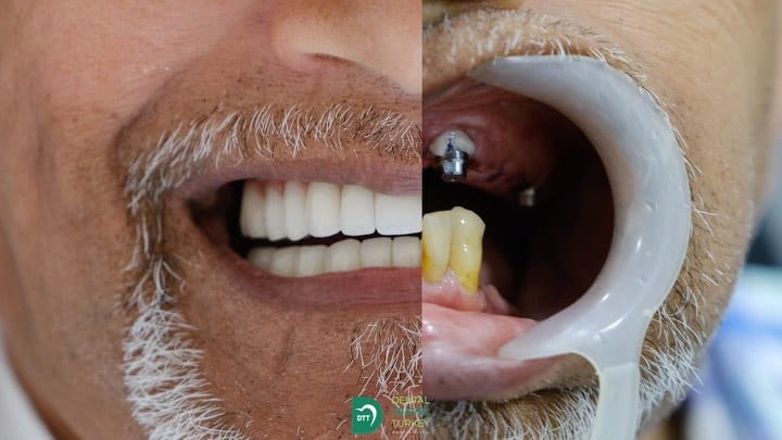Post 9 by Dental Travel Turkey on Instagram (video)
