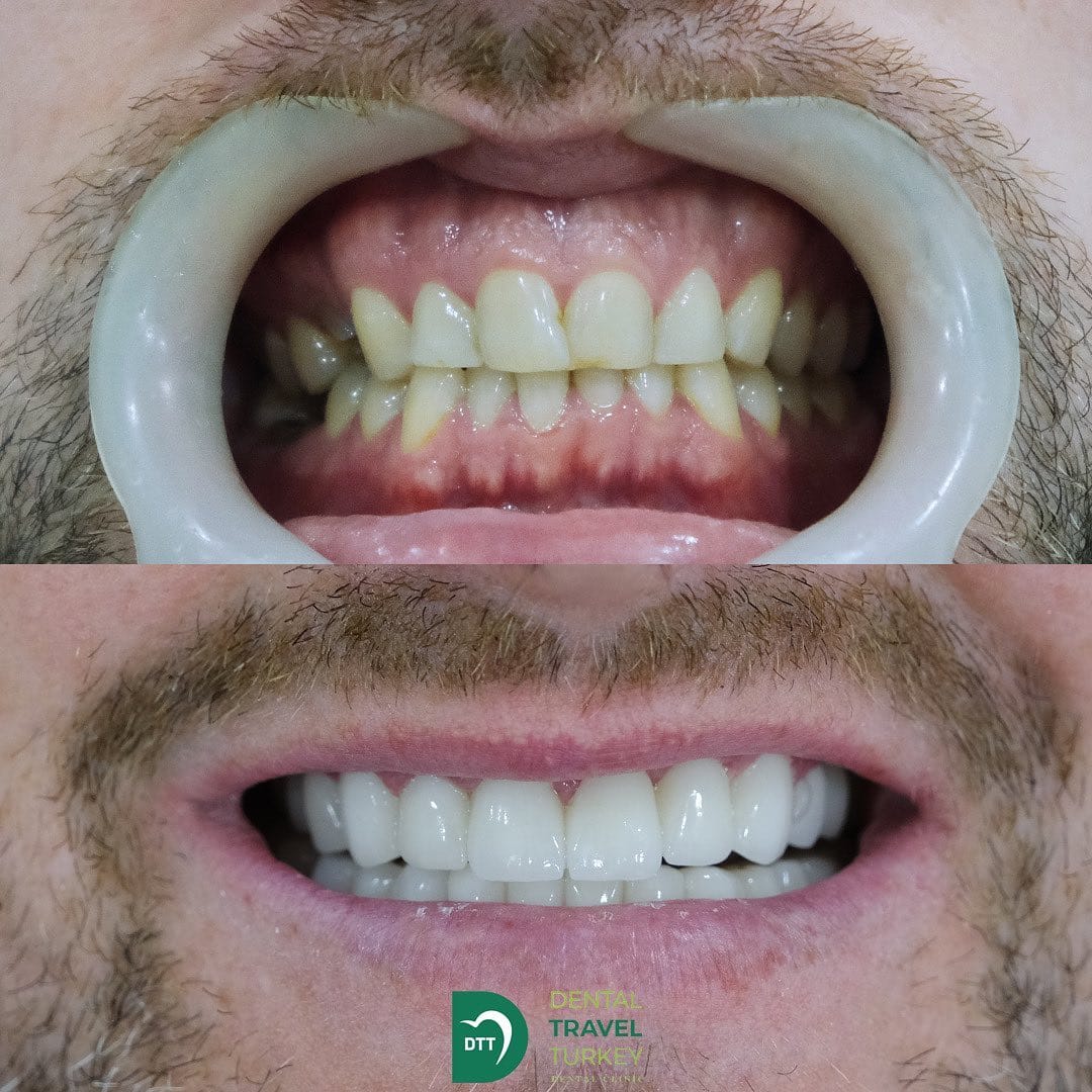 Post 10 by Dental Travel Turkey on Instagram (image)