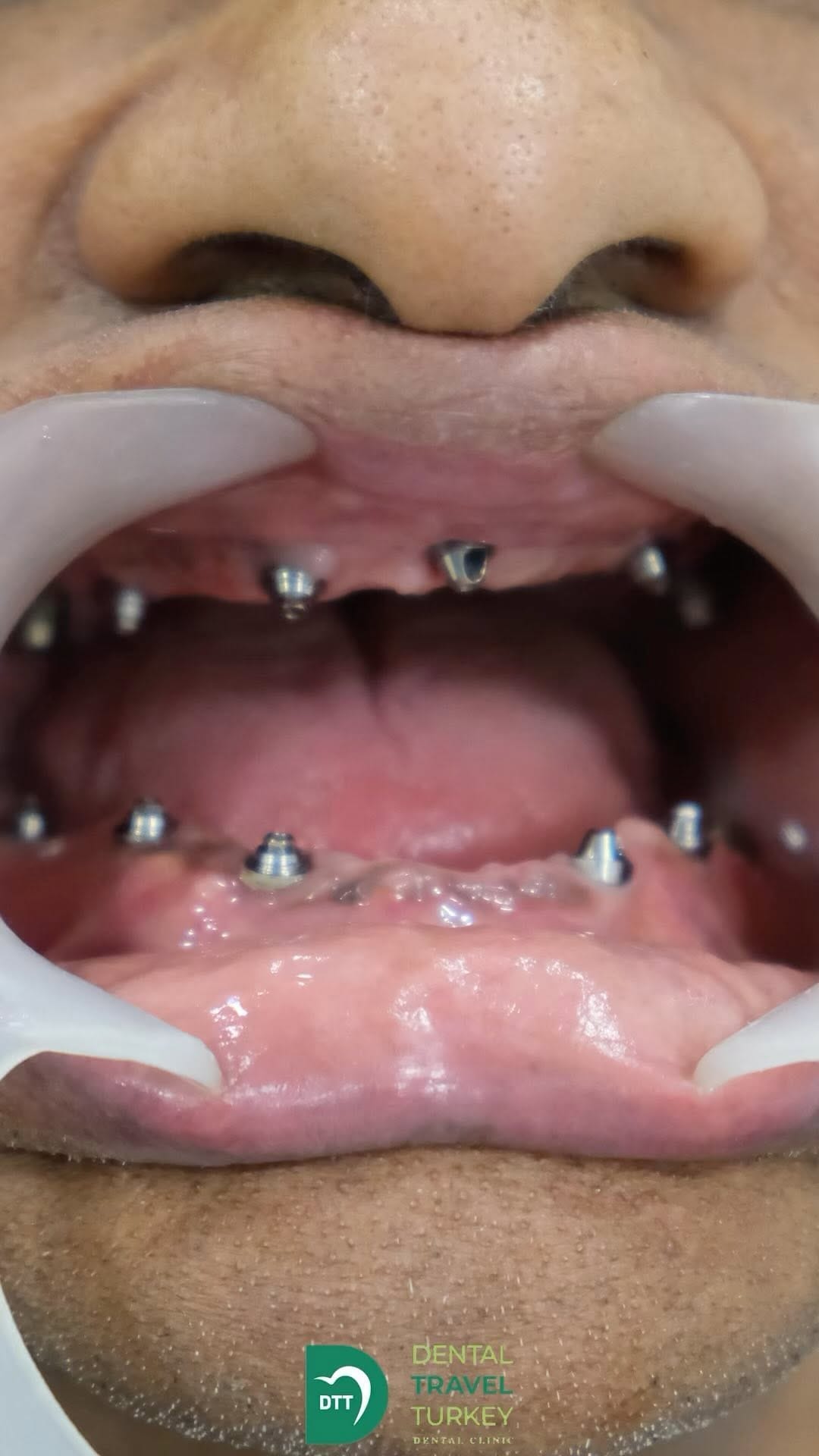 Post 4 by Dental Travel Turkey on Instagram (video)
