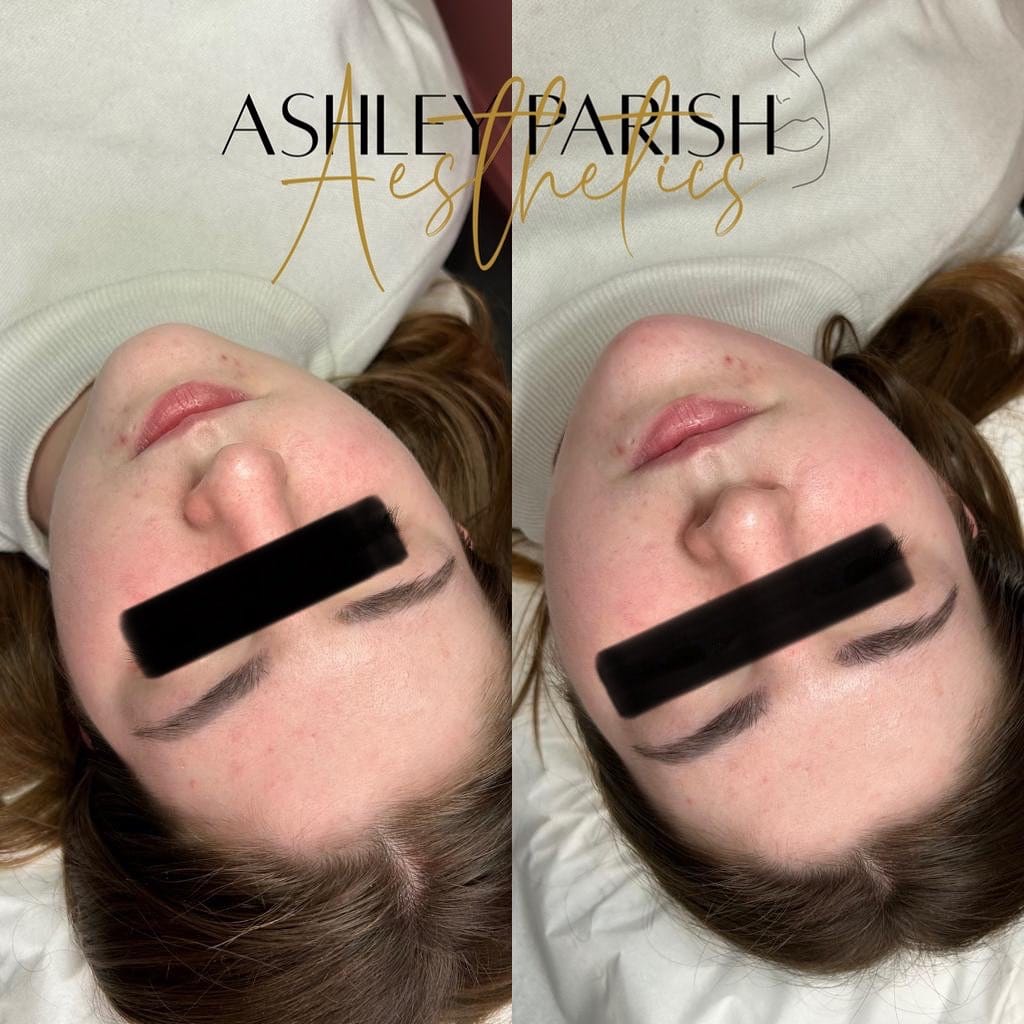 Post 10 by LIP FILLER | NATURAL ENHANCEMENTS | BRIGHTON on Instagram (image)