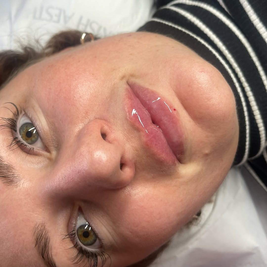 Post 4 by LIP FILLER | NATURAL ENHANCEMENTS | BRIGHTON on Instagram (image)
