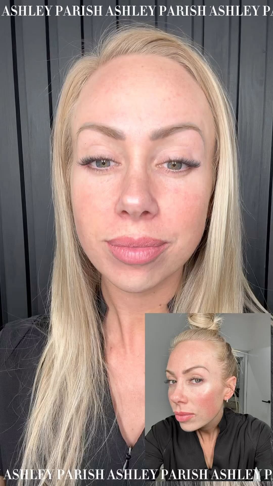 Post 5 by LIP FILLER | NATURAL ENHANCEMENTS | BRIGHTON on Instagram (video)
