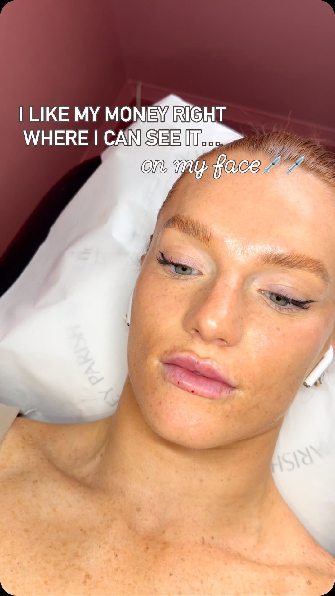 Post 3 by LIP FILLER | NATURAL ENHANCEMENTS | BRIGHTON on Instagram (video)