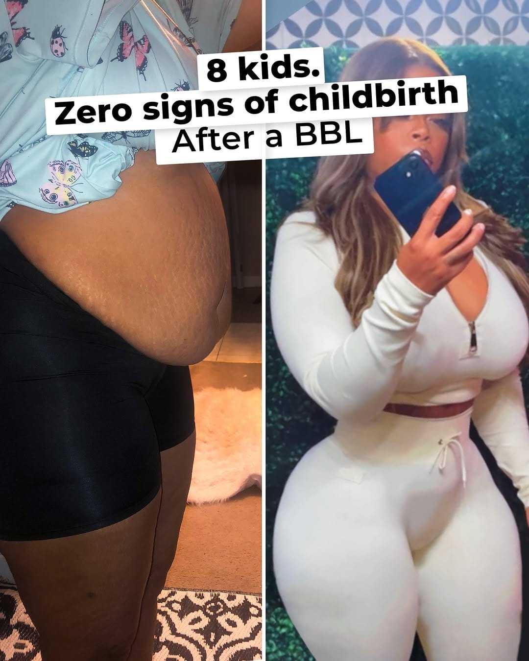 Post 9 by New Life Plastic Surgery Miami on Instagram (carousel)