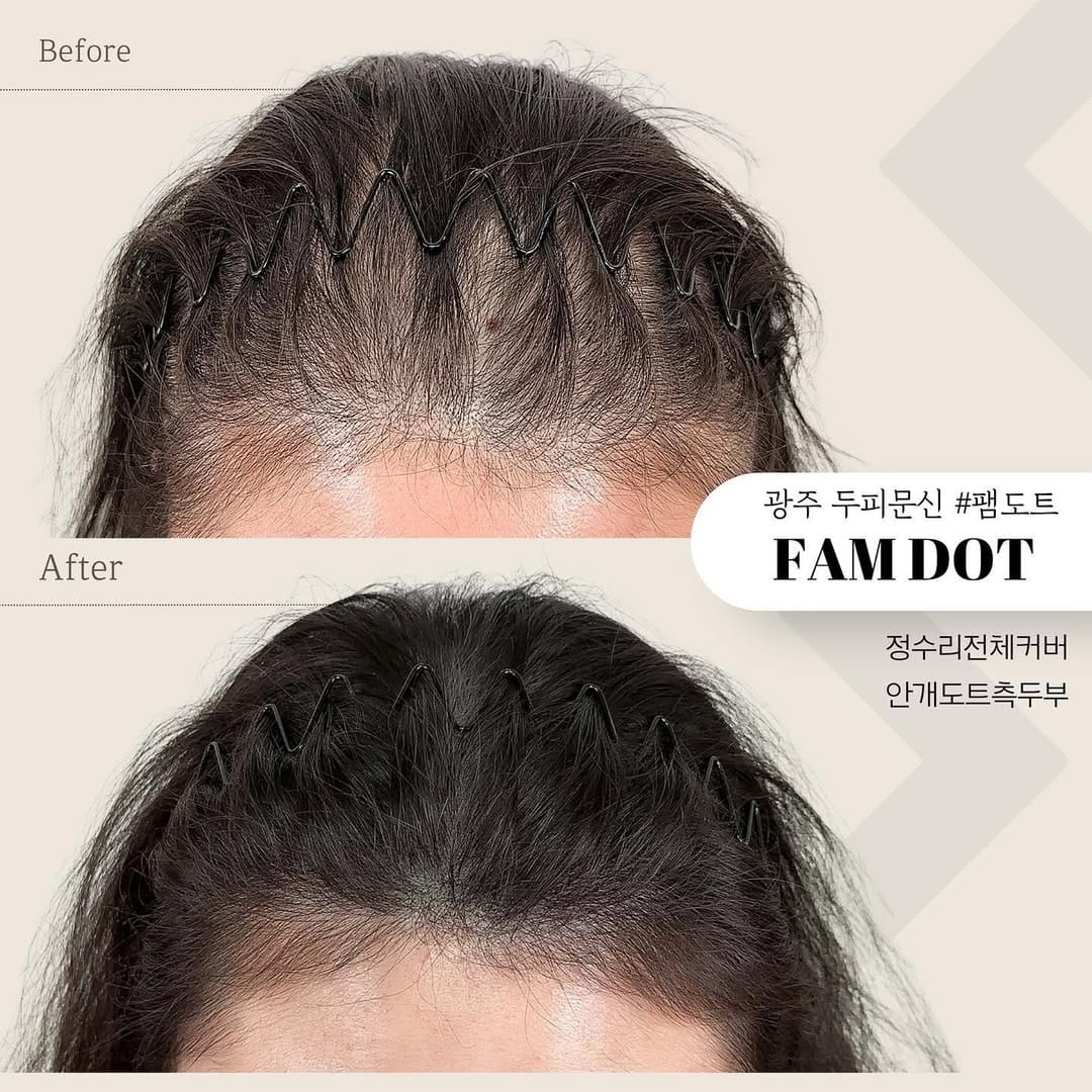 Post 10 by 광주두피문신/안개헤어라인/smp교육 on Instagram (image)