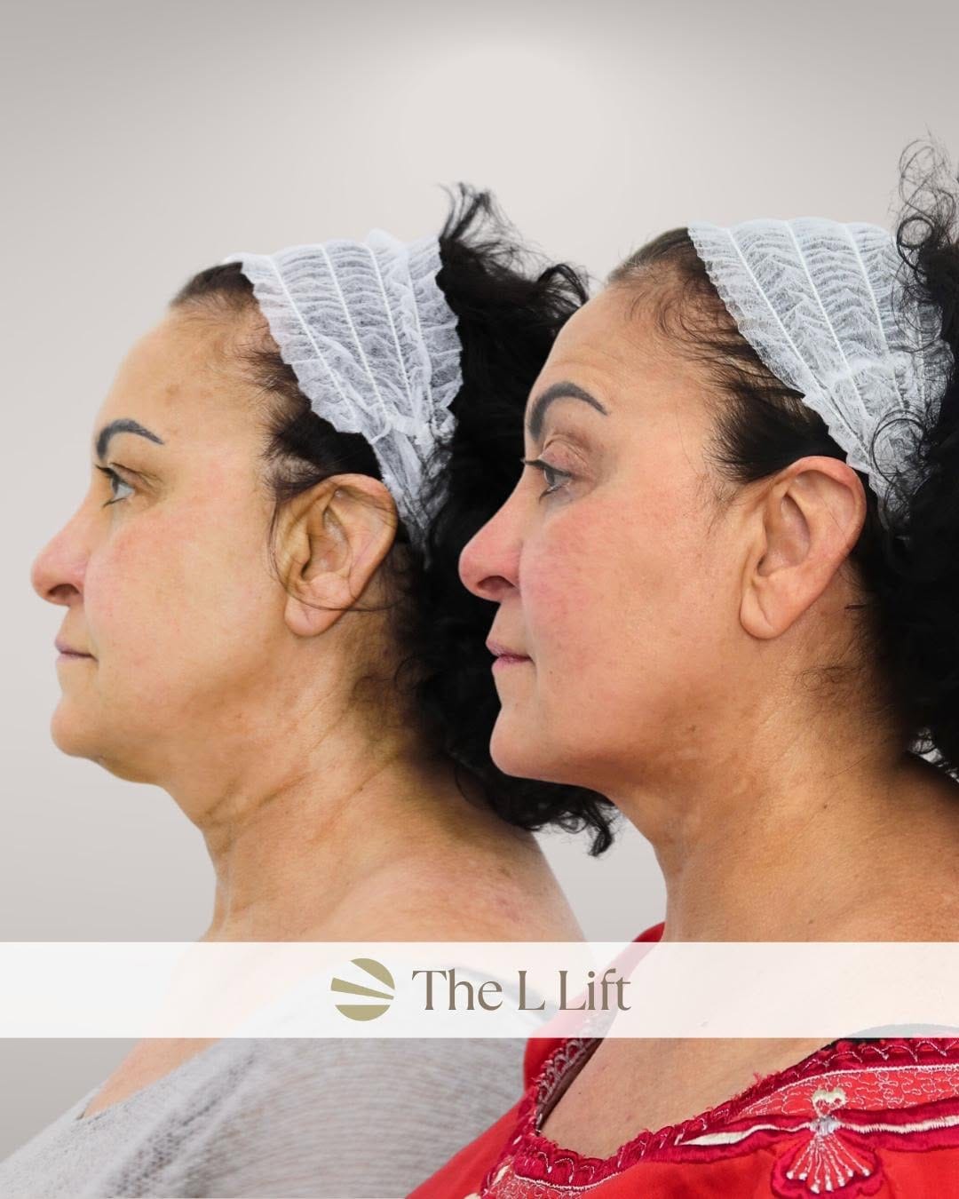 Post 8 by Dr. Leah Skin Clinics London | Most Trusted UK Clinic 2023 on Instagram (image)