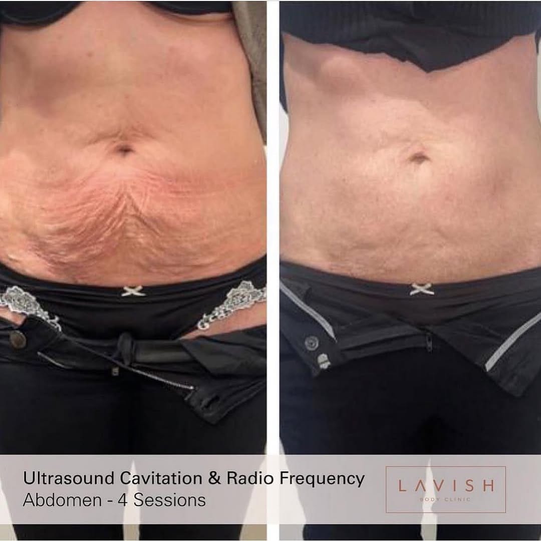 Post 4 by Lavish Body Clinic Marbella 🇪🇸 on Instagram (image)