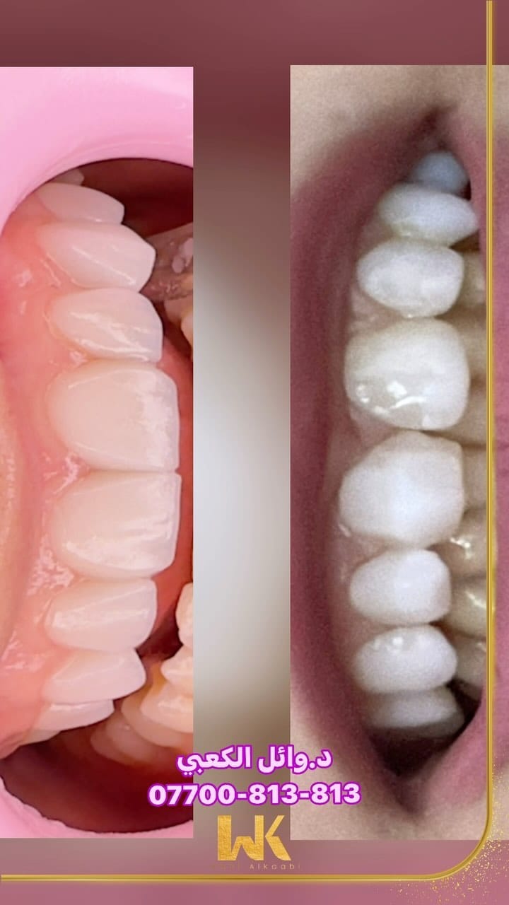 Post 10 by Dr.Wael Alkaabi  🇮🇶🦷 د.وائل الكعبي on Instagram (video)