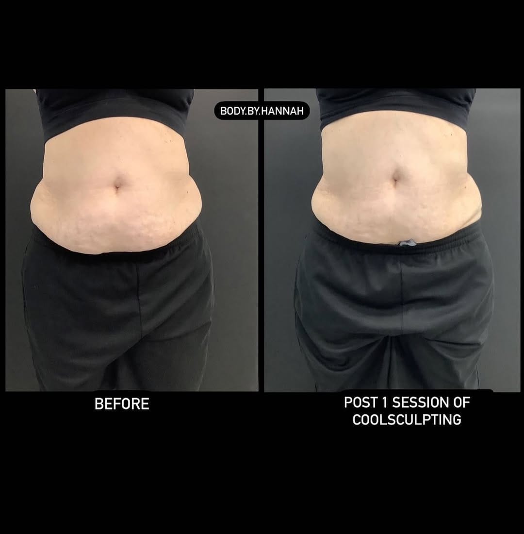 Post 9 by Spa Trouvé CoolSculpting on Instagram (image)