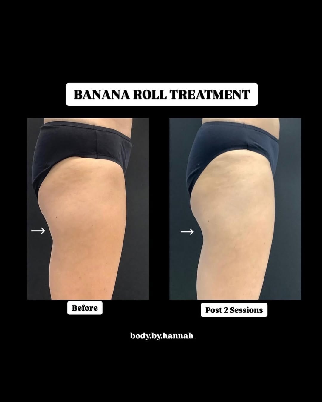 Post 4 by Spa Trouvé CoolSculpting on Instagram (image)