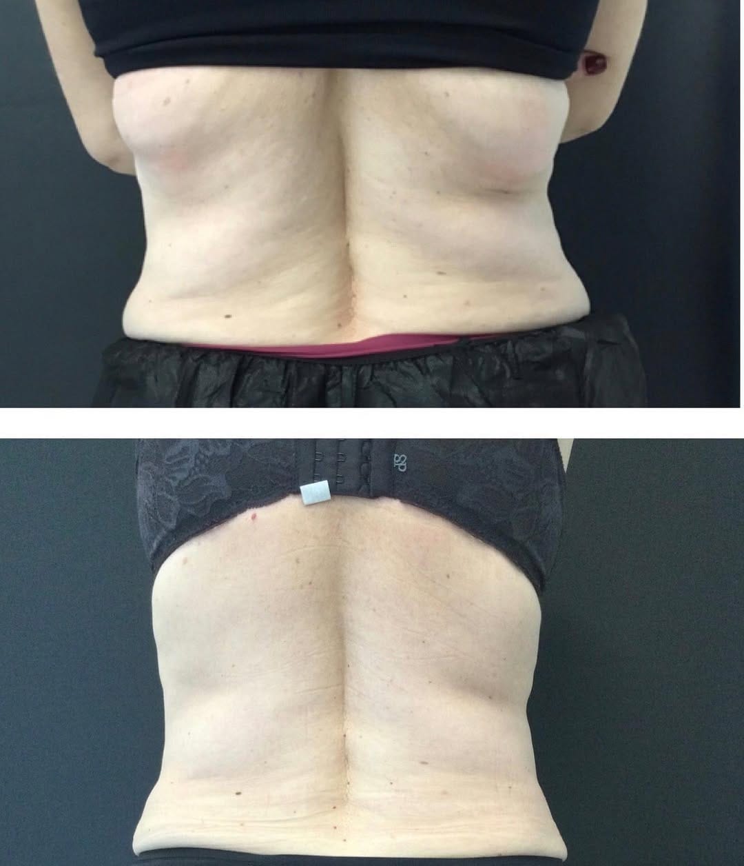 Post 10 by Spa Trouvé CoolSculpting on Instagram (image)