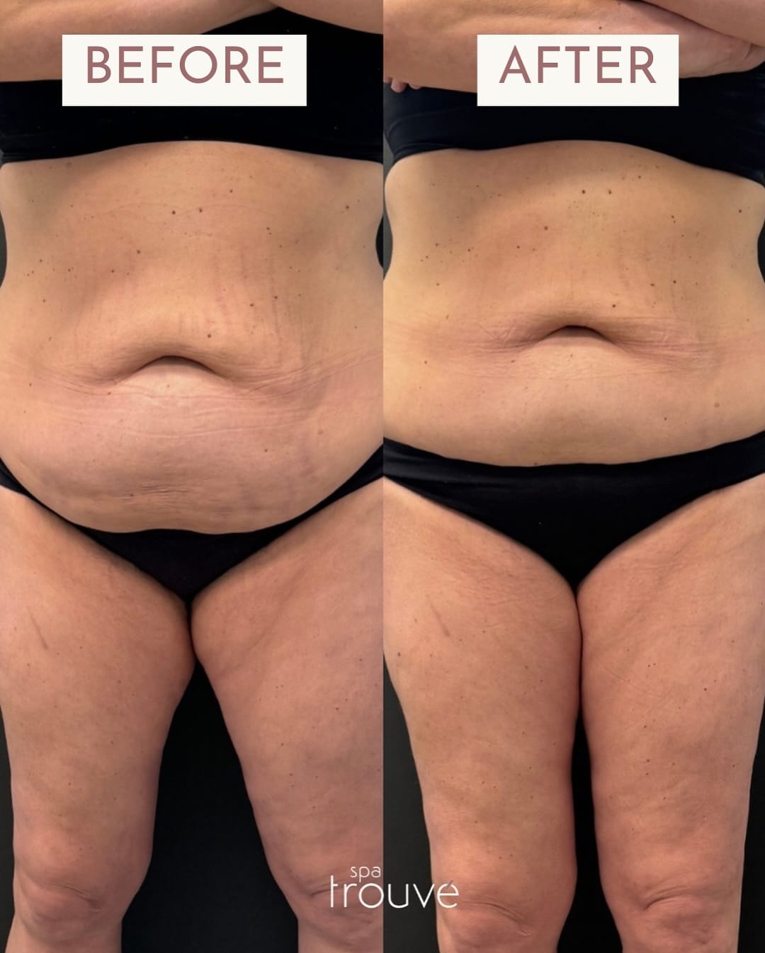 Post 7 by Spa Trouvé CoolSculpting on Instagram (carousel)