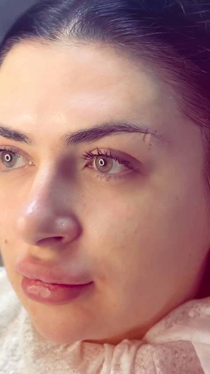 Post 5 by КОСМЕТОЛОГ АНКАРА-КИЕВ💉👄 on Instagram (video)
