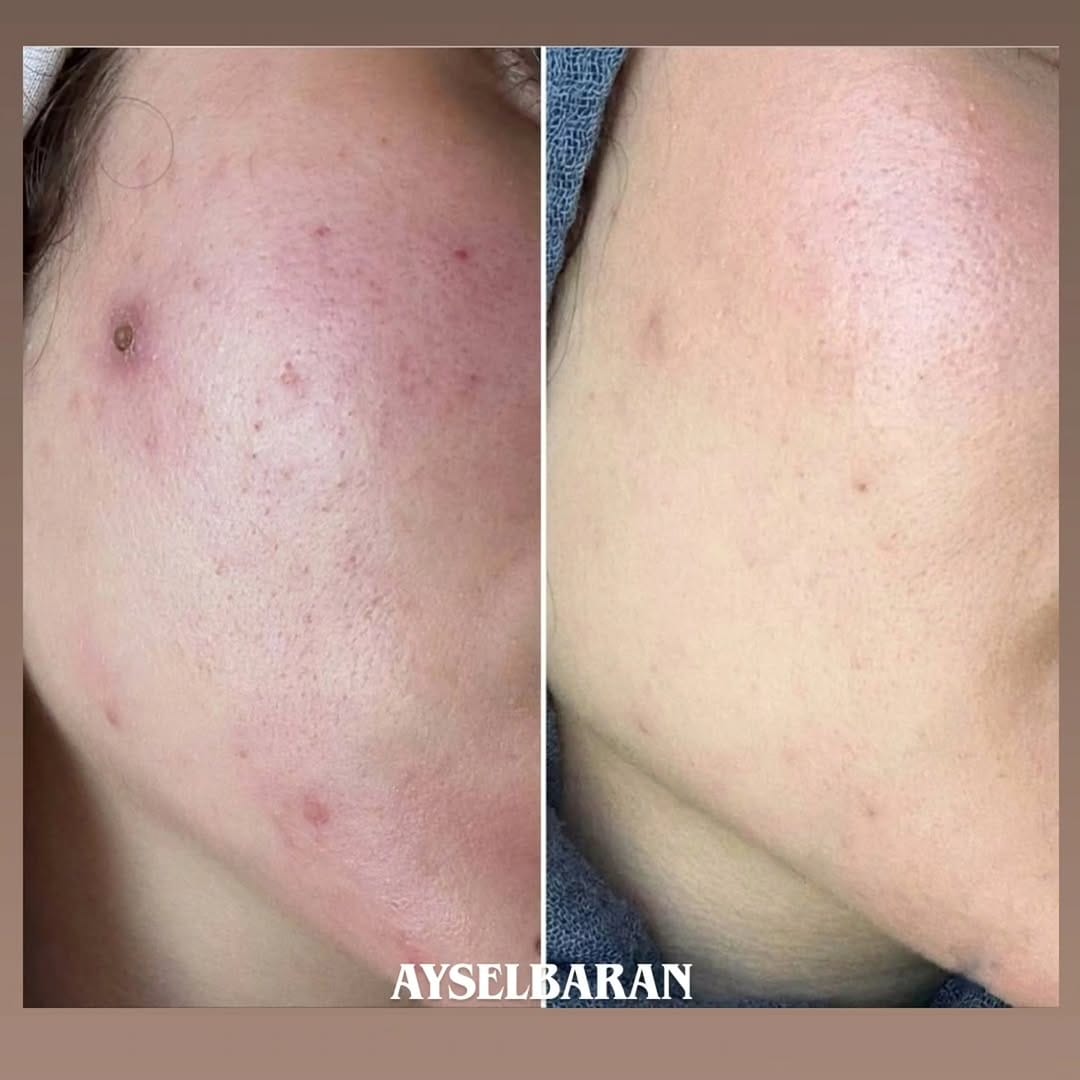 Post 9 by AYSELBARANBEAUTY on Instagram (image)