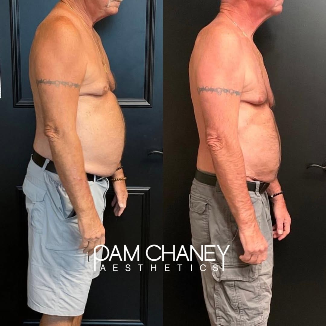 Post 5 by Pam Chaney Aesthetics and Wellness on Instagram (carousel)