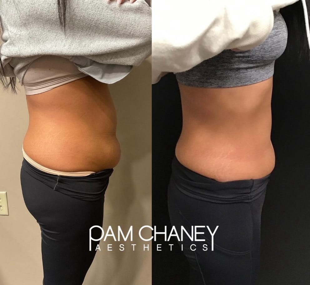 Post 6 by Pam Chaney Aesthetics and Wellness on Instagram (carousel)