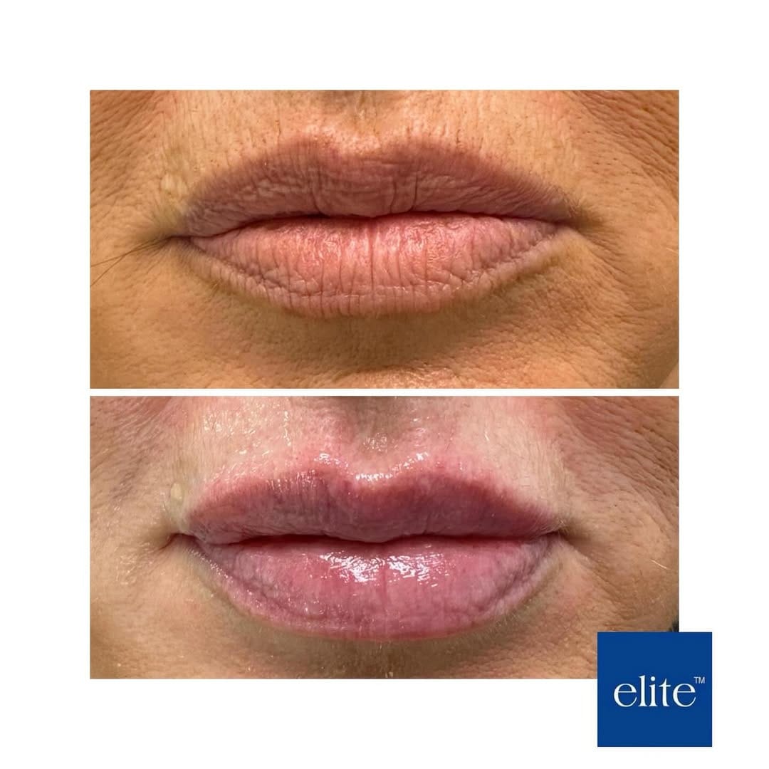 Post 4 by Elite Aesthetic Clinic on Instagram (carousel)