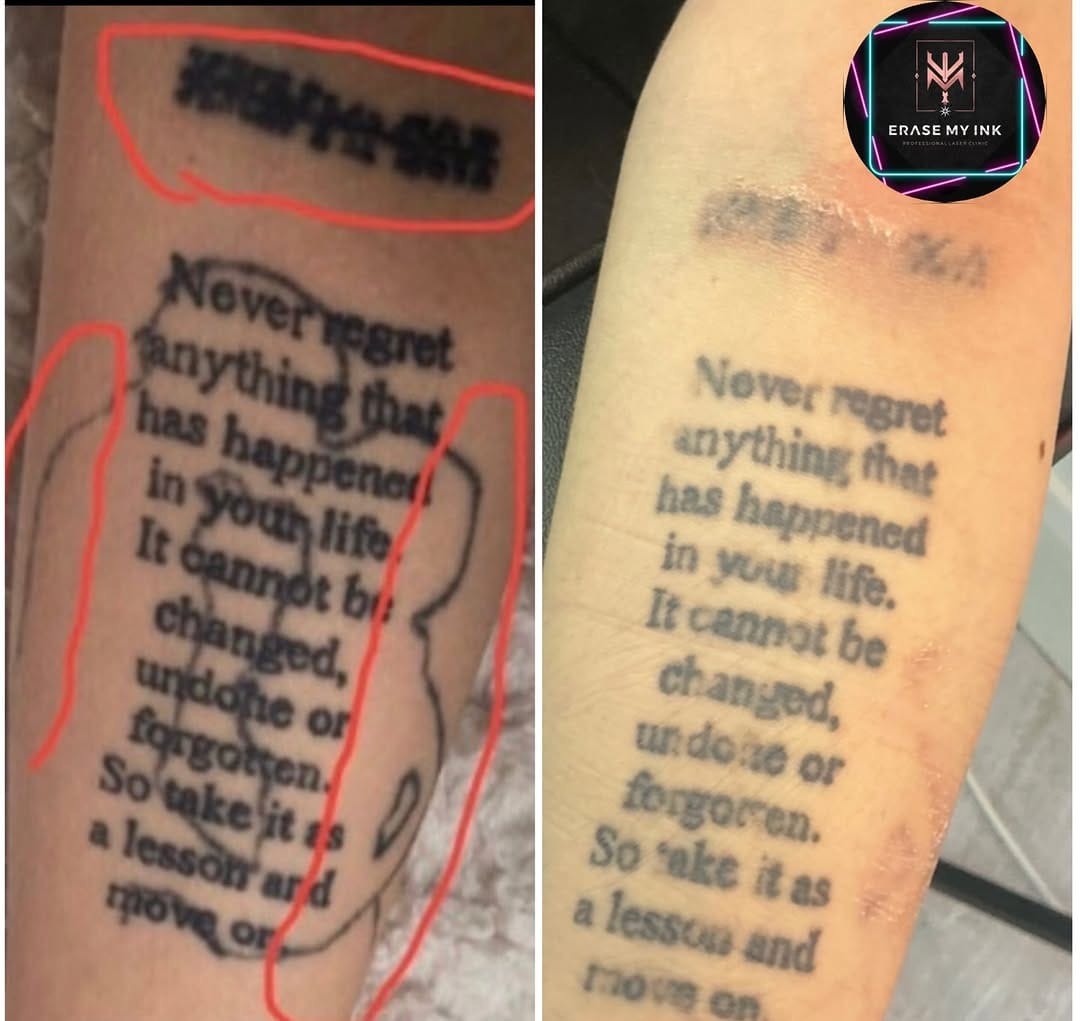 Post 7 by Erase My Ink | Laser Tattoo Removal Essex on Instagram (image)