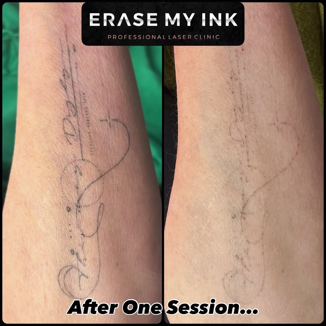Post 1 by Erase My Ink | Laser Tattoo Removal Essex on Instagram (image)