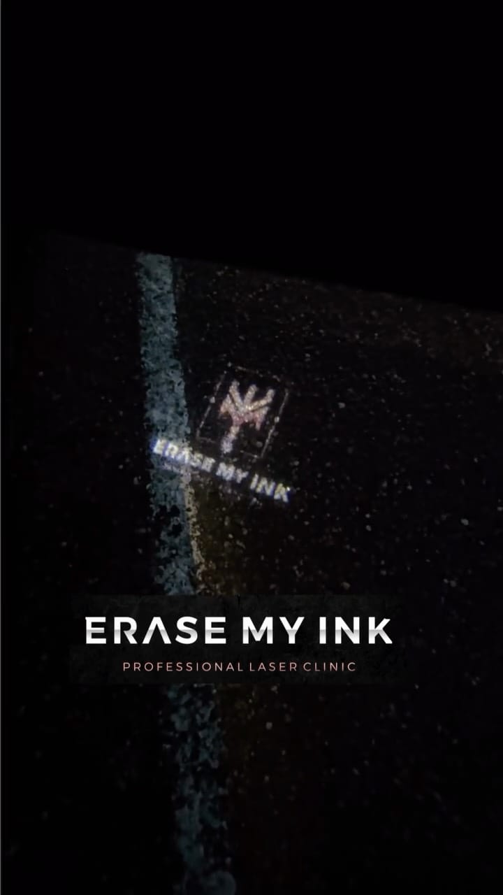 Post 5 by Erase My Ink | Laser Tattoo Removal Essex on Instagram (video)