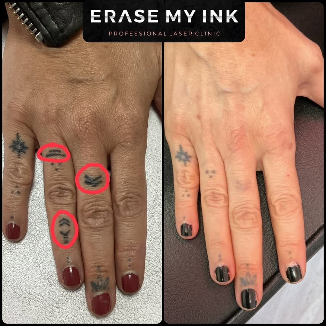 Post 4 by Erase My Ink | Laser Tattoo Removal Essex on Instagram (image)
