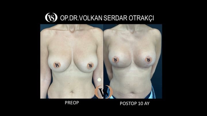 Post 2 by Op. Dr. Volkan Serdar Otrakçı on Instagram (carousel)