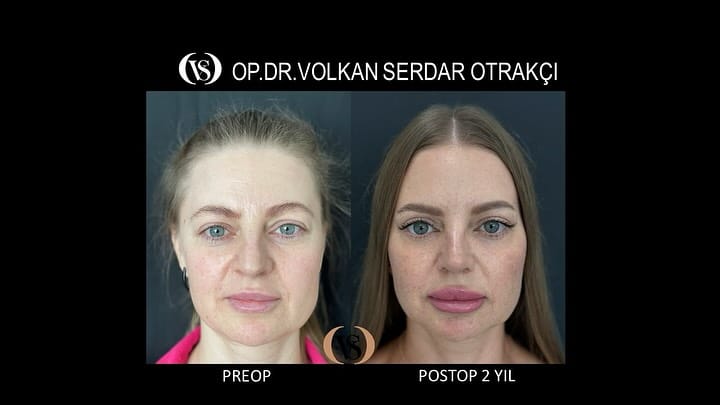Post 5 by Op. Dr. Volkan Serdar Otrakçı on Instagram (carousel)