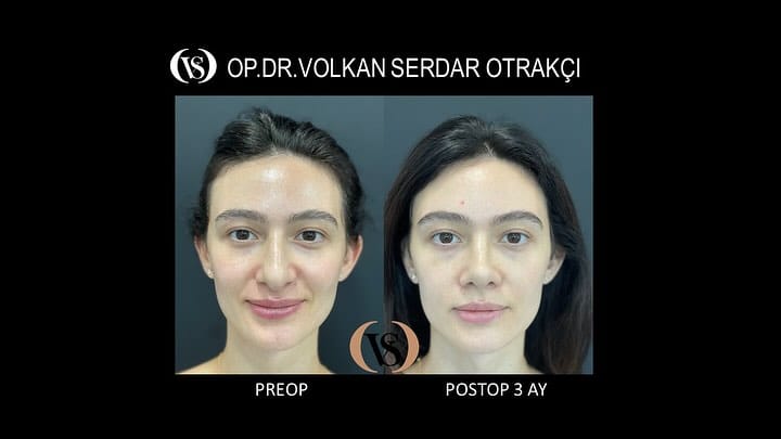 Post 8 by Op. Dr. Volkan Serdar Otrakçı on Instagram (carousel)
