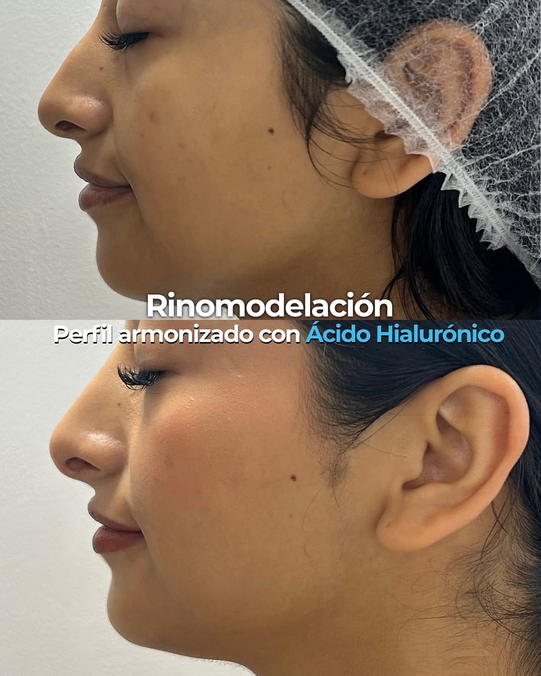 Post 1 by Clínica Estética | Bótox • Fillers • Endolyse • Bioest.• CO2 Fdo on Instagram (image)
