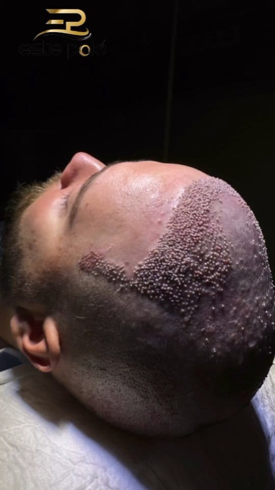 Post 1 by EstePolo Hair Transplant 👨🏻‍🦲🔁🧔🏻 on Instagram (video)