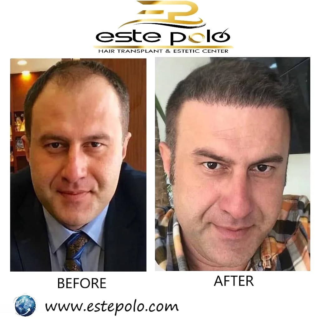 Post 10 by EstePolo Hair Transplant 👨🏻‍🦲🔁🧔🏻 on Instagram (image)